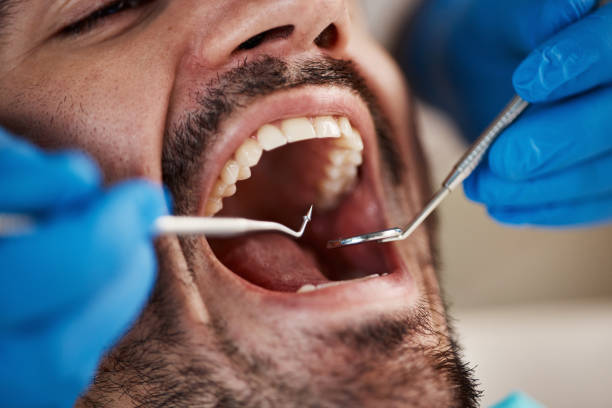 Best Emergency Dentist for Lost Fillings or Crowns in Dry Run, OH